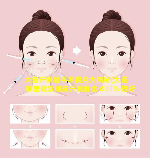 大连开眼睑手术费用大揭秘(大连哪里做双眼皮开眼角比 🌼 较好啊)